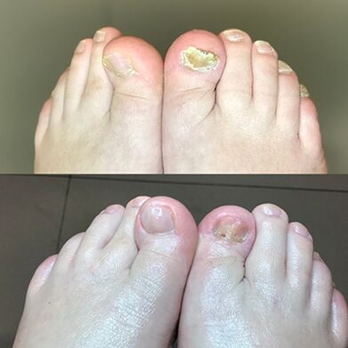 Esperienza nell'uso di barnabas di crema promici da Israele, foto prima e dopo