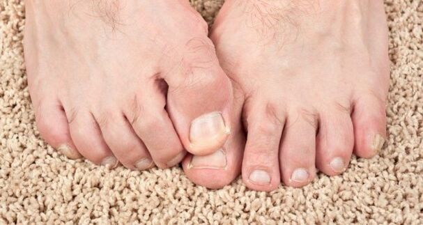 Sintomi di funghi unghie