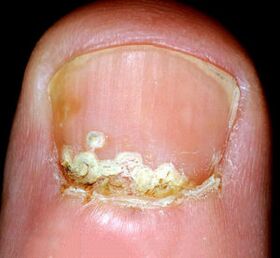 Sintomi e segni della malattia