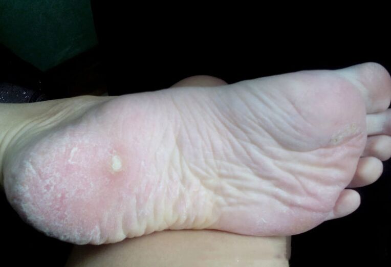 Trattamento del fungo con un laser