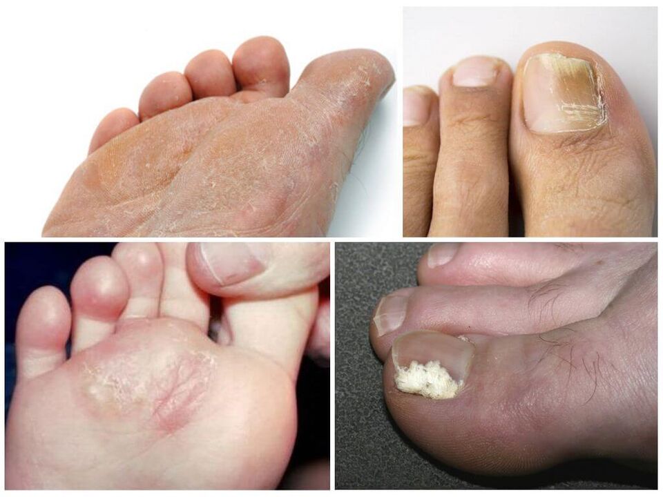 La fase iniziale del piede d'atleta