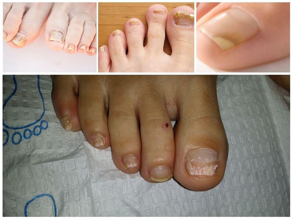 Malattie fungine delle unghie