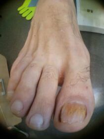 Fungo delle unghie sull'alluce