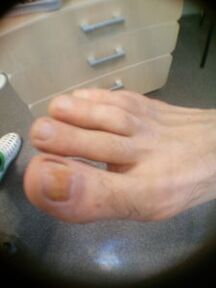 Stadio iniziale del fungo dell'unghia dell'alluce