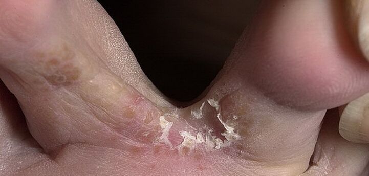 Fungo tra le dita dei piedi