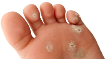 seconda fase di un'infezione fungina