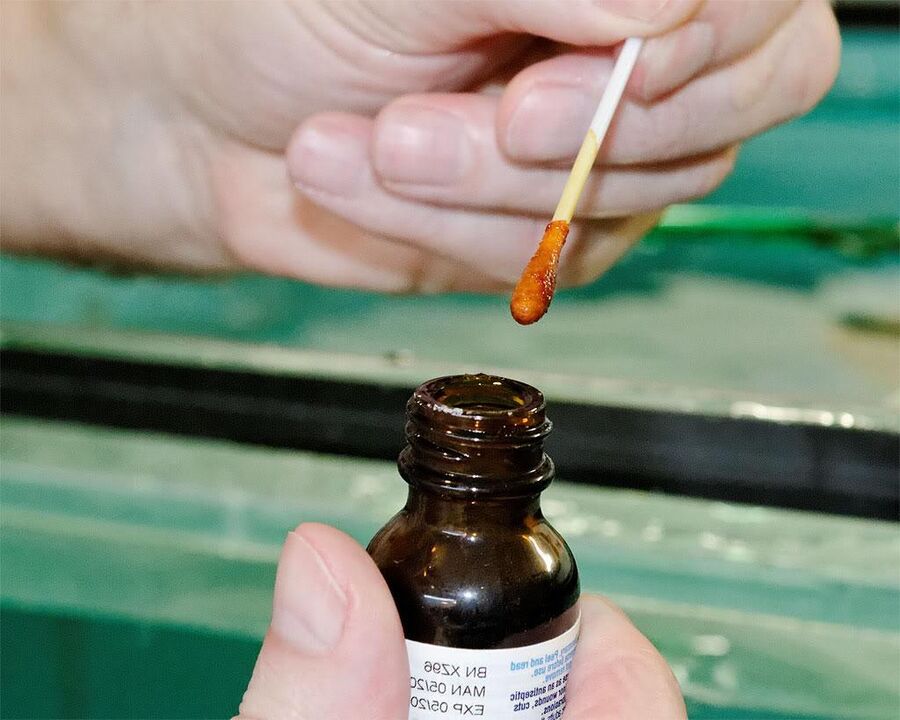 L’applicazione di una miscela di iodio e succo di celidonia sulle unghie dei piedi elimina il fungo