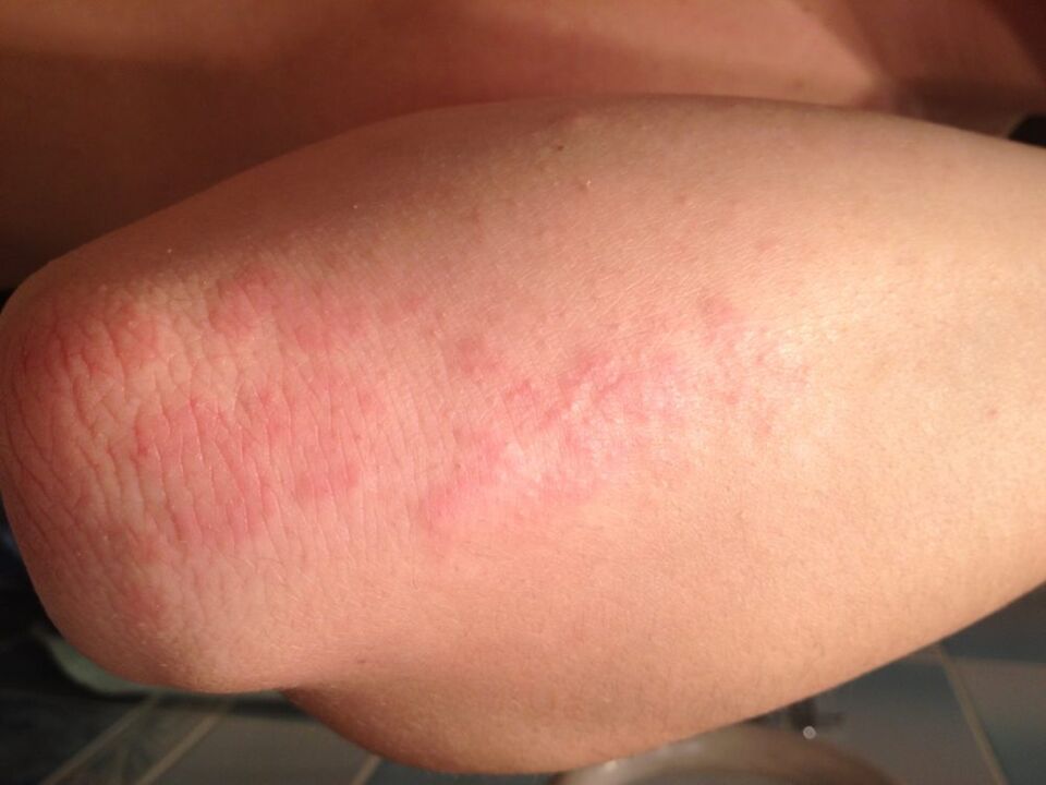 Una reazione allergica sotto forma di eruzione cutanea sulla pelle del gomito dopo aver applicato una goccia di succo di celidonia